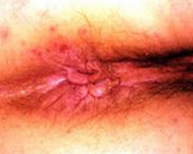 Hardin MD : Skin Rashes : Picture Gallery