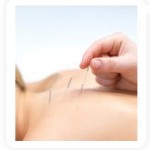 Acupuncture