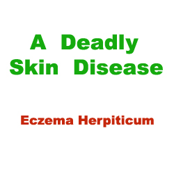 Skin Disease Eczema Herpiticum Skin Disease Eczema Herpiticum