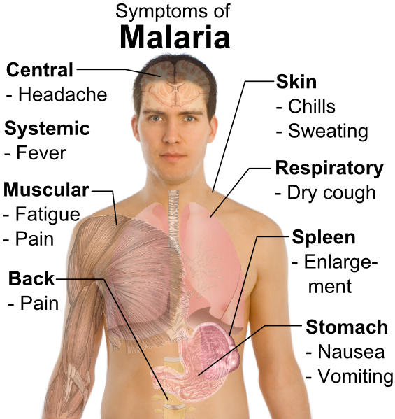 Symptoms signs Malaria
