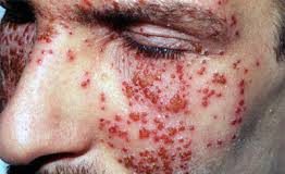 eczema herpeticum