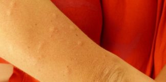 Itchy arm and/or hands