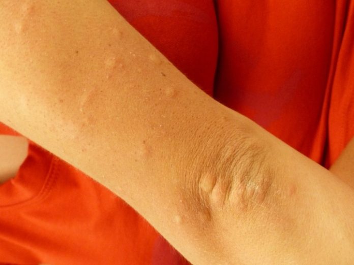 Itchy arm and/or hands