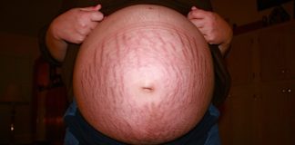 how to get rid of stretch marks