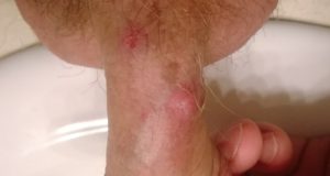 folliculitis pénisz