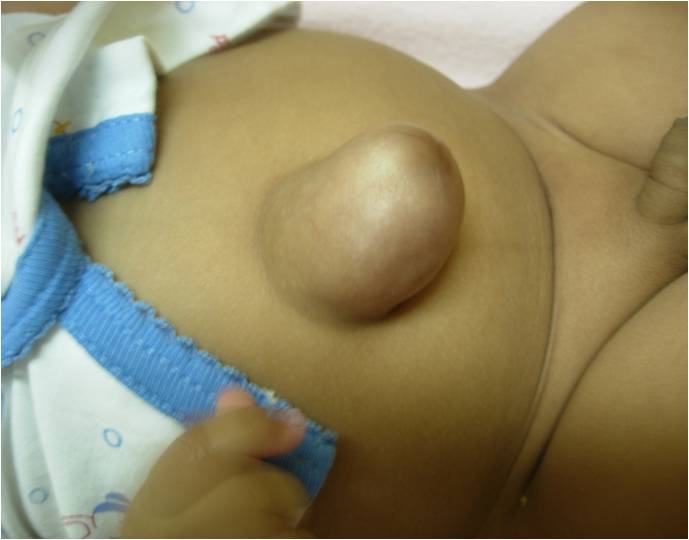 umbilical hernia children