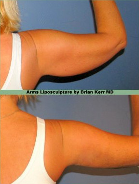 arms liposculpture smarliposuction