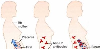 erythroblastosis fetalis