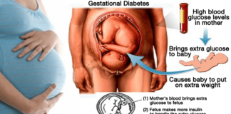 gestational diabetes