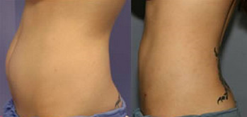 smartlipo abdomen