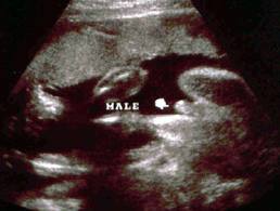 week 17ultrasound determining gender