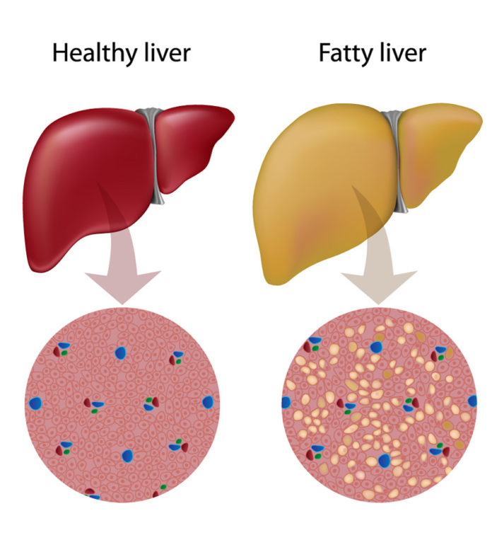 fatty liver fatty liver