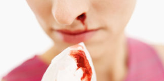 nose bleed