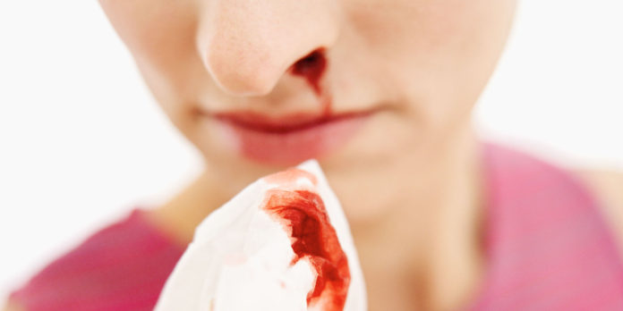 nose bleed nose bleed