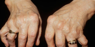 rheumatoid arthritis