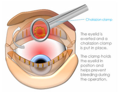 eye cyst- I & C 2