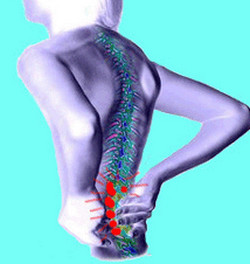 degenerative disc disease