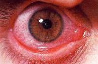 allergic congunctivitis pictures
