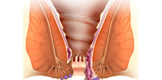 hemorrhoids