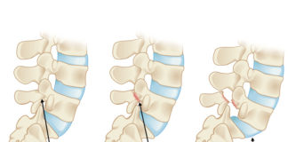 spondylolisthesis