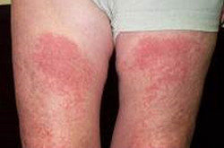 Sun Poisoning Rash PICTURE