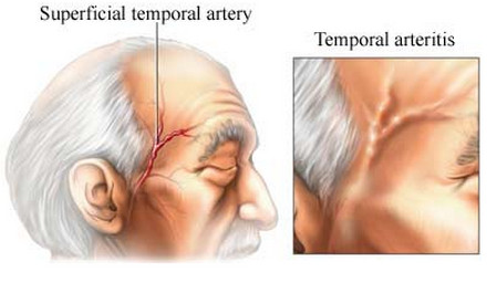 temporal arteritis (giant cell arteritis)