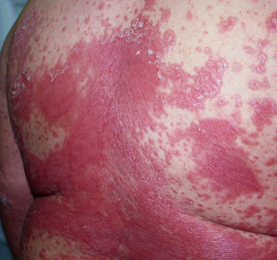 Plaque Psoriasis on back severe