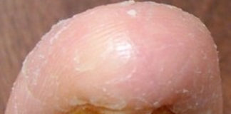 bigtoe yellow toenail