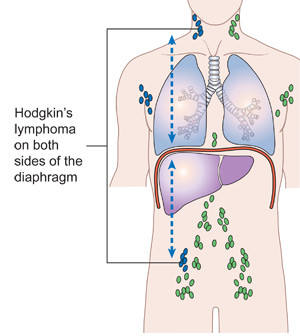 Hodgkins disease stage 3
