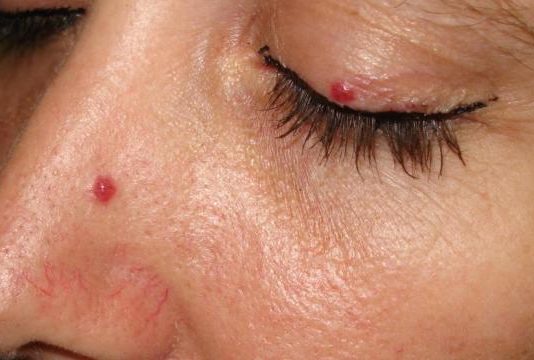 cherry angioma pictures
