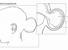 Occipital Encephalocele
