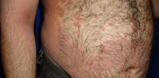 Pityriasis versicolor skin bleaching
